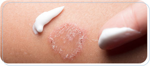 How to Get Rid of Ringworm Near Me in Downtown Long Beach Bixby Knolls and Paramount CA How to Get Rid of Ringworm Near Me in Downtown Long Beach Bixby Knolls and Paramount CA