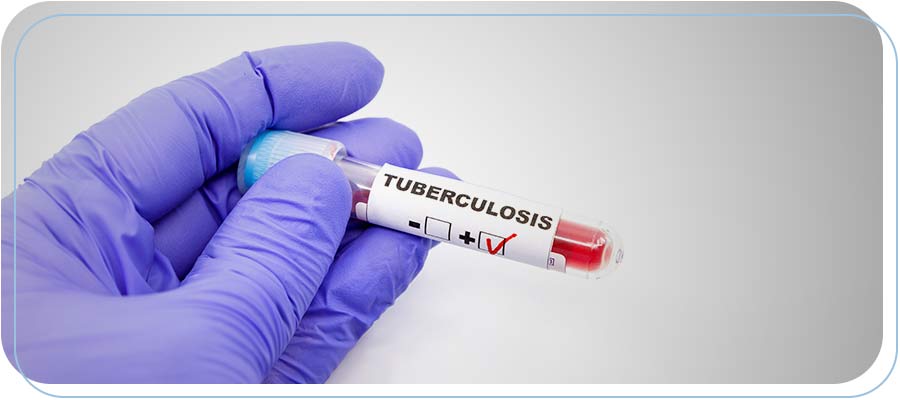 Tuberculosis Testing Near Me in Downtown Long Beach CA, Bixby Knolls Long Beach CA, and Paramount CA. Tuberculosis Testing Near Me in Downtown Long Beach CA, Bixby Knolls Long Beach CA, and Paramount CA.