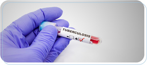 Tuberculosis Testing Near Me in Downtown Long Beach CA, Bixby Knolls Long Beach CA, and Paramount CA. Tuberculosis Testing Near Me in Downtown Long Beach CA, Bixby Knolls Long Beach CA, and Paramount CA.