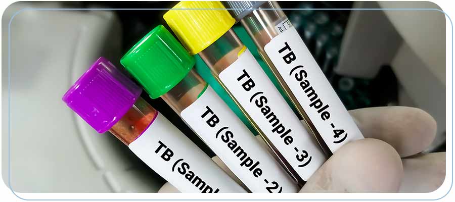 Where Do I Get a TB Test? | Reddy Urgent Care Near Me in Downtown Long Beach, Bixby Knolls, and Paramount, CA Where Do I Get a TB Test? | Reddy Urgent Care Near Me in Downtown Long Beach, Bixby Knolls, and Paramount, CA