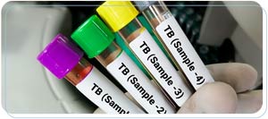 Where Do I Get a TB Test? | Reddy Urgent Care Near Me in Downtown Long Beach, Bixby Knolls, and Paramount, CA Where Do I Get a TB Test? | Reddy Urgent Care Near Me in Downtown Long Beach, Bixby Knolls, and Paramount, CA